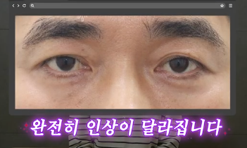 전현무도 한 중년수술, 이게 현실입니다 사진 16