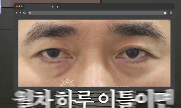 전현무도 한 중년수술, 이게 현실입니다 사진 15