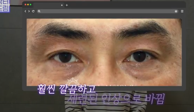 전현무도 한 중년수술, 이게 현실입니다 사진 13