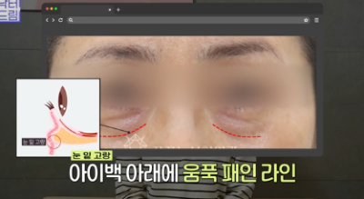 전현무도 한 중년수술, 이게 현실입니다 사진 7