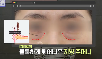 전현무도 한 중년수술, 이게 현실입니다 사진 6