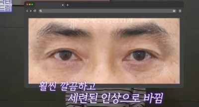 전현무도 한 중년수술, 이게 현실입니다 사진 14