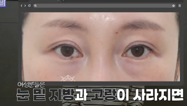 전현무도 한 중년수술, 이게 현실입니다 사진 17