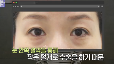 전현무도 한 중년수술, 이게 현실입니다 사진 22