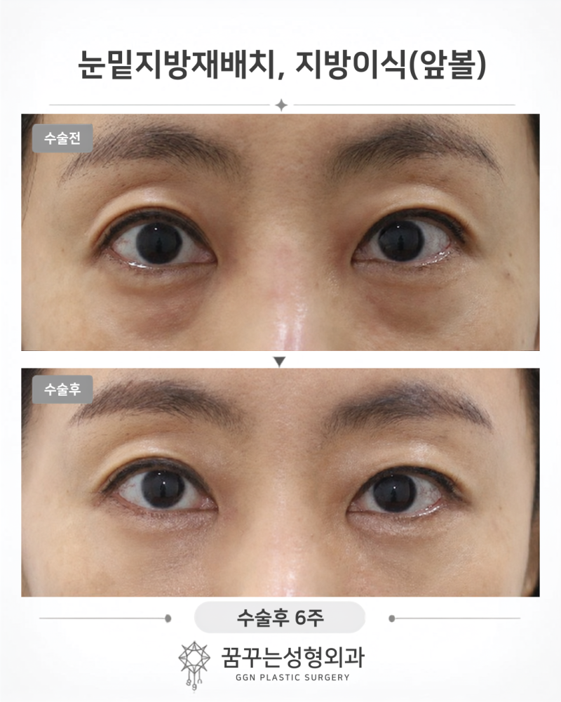 요새 누가 티 나게 성형해요? 자연스러운 성형 추천, 강남역 꿈꾸는성형외과 사진 7