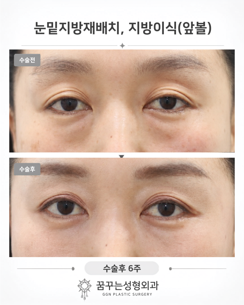 요새 누가 티 나게 성형해요? 자연스러운 성형 추천, 강남역 꿈꾸는성형외과 사진 6