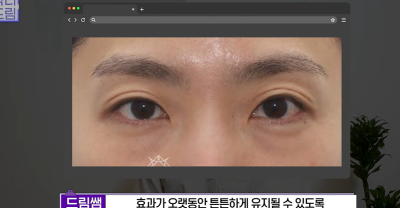 1000명 상안검수술 해준 의사가 아내는 안해준 이유 사진 28
