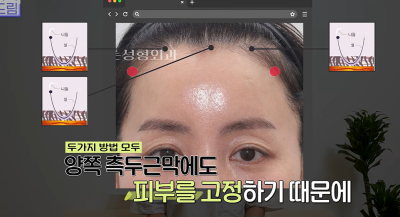 1000명 상안검수술 해준 의사가 아내는 안해준 이유 사진 27