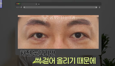 1000명 상안검수술 해준 의사가 아내는 안해준 이유 사진 21