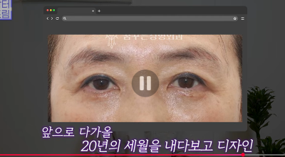 1000명 상안검수술 해준 의사가 아내는 안해준 이유 사진 31