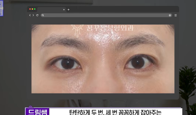 1000명 상안검수술 해준 의사가 아내는 안해준 이유 사진 29