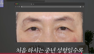 1000명 상안검수술 해준 의사가 아내는 안해준 이유 사진 30