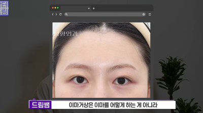 1000명 상안검수술 해준 의사가 아내는 안해준 이유