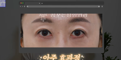 1000명 상안검수술 해준 의사가 아내는 안해준 이유 사진 17