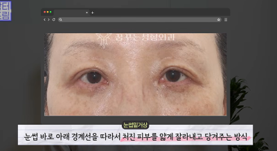 1000명 상안검수술 해준 의사가 아내는 안해준 이유 사진 19