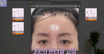 1000명 상안검수술 해준 의사가 아내는 안해준 이유 사진 26