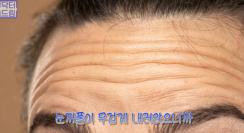 1000명 상안검수술 해준 의사가 아내는 안해준 이유 사진 2