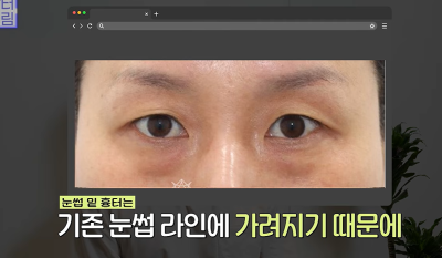1000명 상안검수술 해준 의사가 아내는 안해준 이유 사진 22