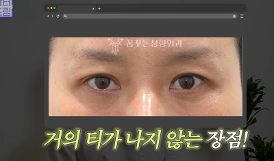 1000명 상안검수술 해준 의사가 아내는 안해준 이유 사진 23